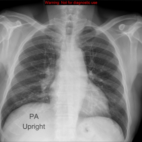 Chest radiography