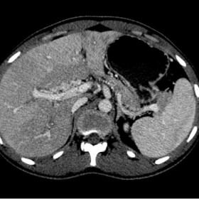 Contrast enhanced CT abdomen