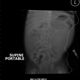X-Ray abdomen (plain)