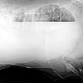 Plain abdominal X-ray