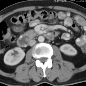 Axial CT abdomen reveals multiple vessels in small bowel