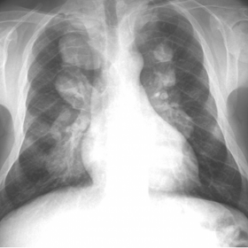 Chest PA radiography