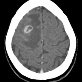 Axial CT, post-contrast