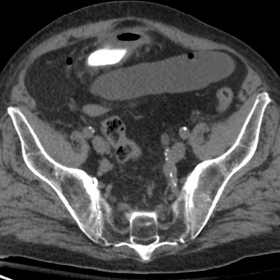 Axial unenhanced CT image