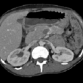 Huge cystic mass: wandering spleen