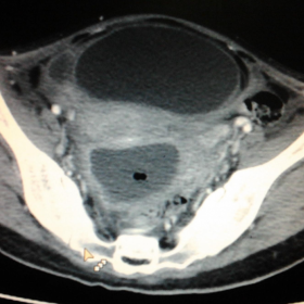 Pre-interventional CECT pelvis axial image