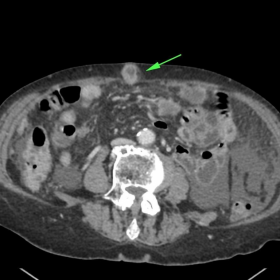 Contrast enhanced axial CT abdomen