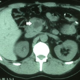 Two years follow up abdominal CT scan