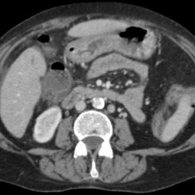 Postcontrast axial CT shows