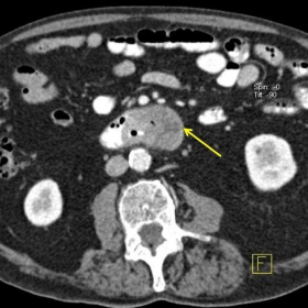 Abdominal CT postadministration of IV and oral contrast
