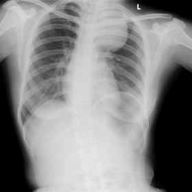 PA Chest X-ray