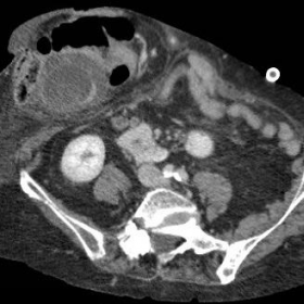 CT showing cholecystitis within a parastomal hernia