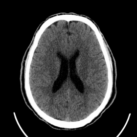 Axial cerebral non-enhanced CT examination
