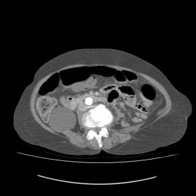 Axial CT with contrast