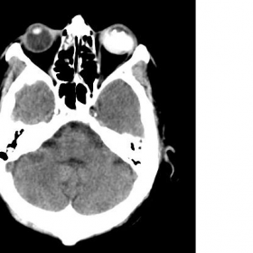 Axial CT head