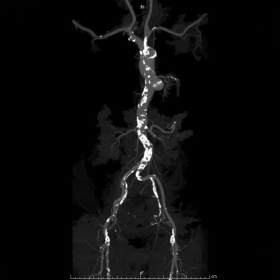 Panoramic view of the thoraco-abdominal aorta and its branches