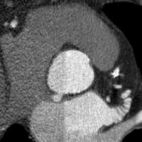 Aortic abscess: 2D and 3D images
