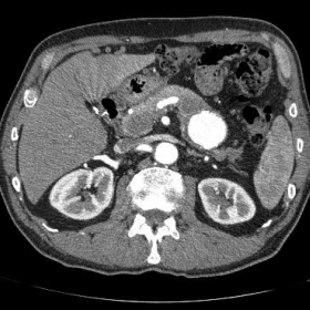 CT showing a 5.3 cm splenic artery pseudoaneurysm
