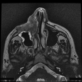 MRI findings: T2-weighted images