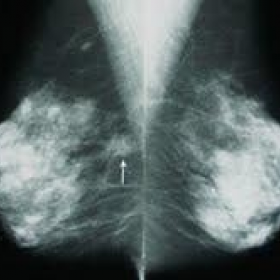 Film-Screen mammography