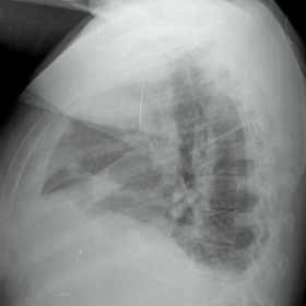 Chest radiograph, lateral projection