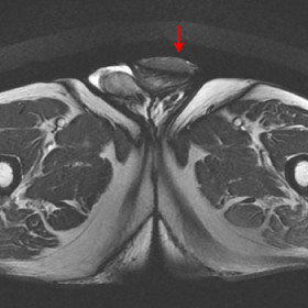 Penile cancer: MRI diagnosis