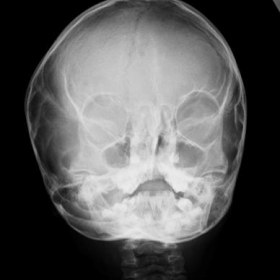 Skull X-rays