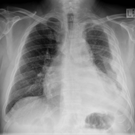 Serial chest radiographs