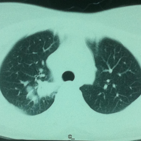 CT of the chest on lung window