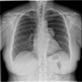 Posteroanterior chest radiograph