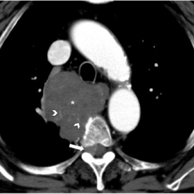 Contrast-enhanced CT of the chest