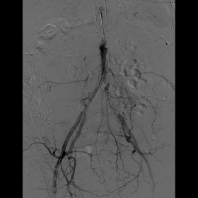 Angiography and endovascular treatment