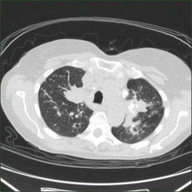 Chest CT on lung window