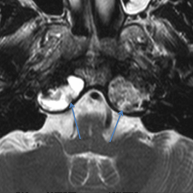 Axial T2-weighted image (TR/TE = 3200/100; slice = 3mm)