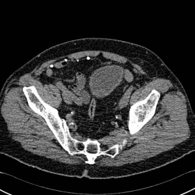 CT lower abdomen with valsalva axial plane