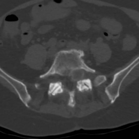 NCCT scanning of lumbo-sacral spine