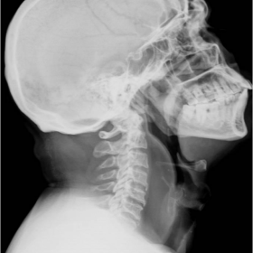 Lateral cervical spine X-ray