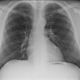 Chest radiograph (April 2004)