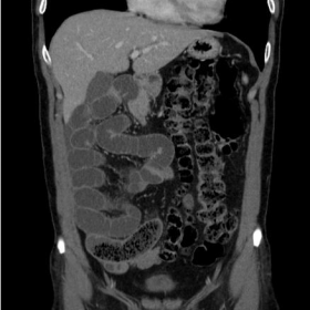 Contrast enhanced abdominal CT on coronal plane