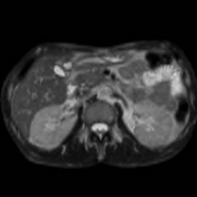 Initial unenhanced and gadolinium-enhanced abdominal MRI