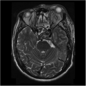 MRI performed on suspicion of aneurysm rupture