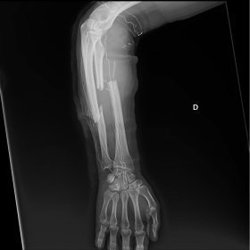 X-ray findings