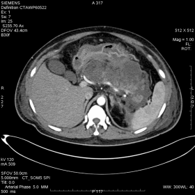 Contrast enhanced CT Abdomen