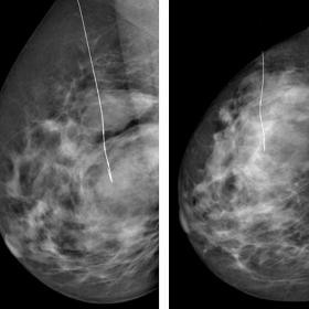 RMLO and RCC mammograms of the right breast