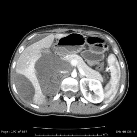 First CT that reveals a relapse of Wilms tumour