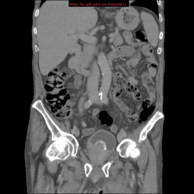 Coronal reconstructed image through the urinary bladder