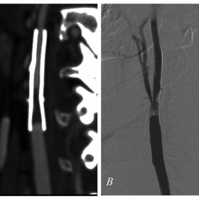 Preprocedural CT and Fluoroscopic angiography
