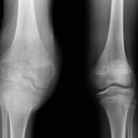 Knees - Frontal X-ray