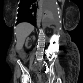 Body multidetector CT with contrast medium administration via femoral CVC