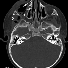 CT head, axial view, bone window level